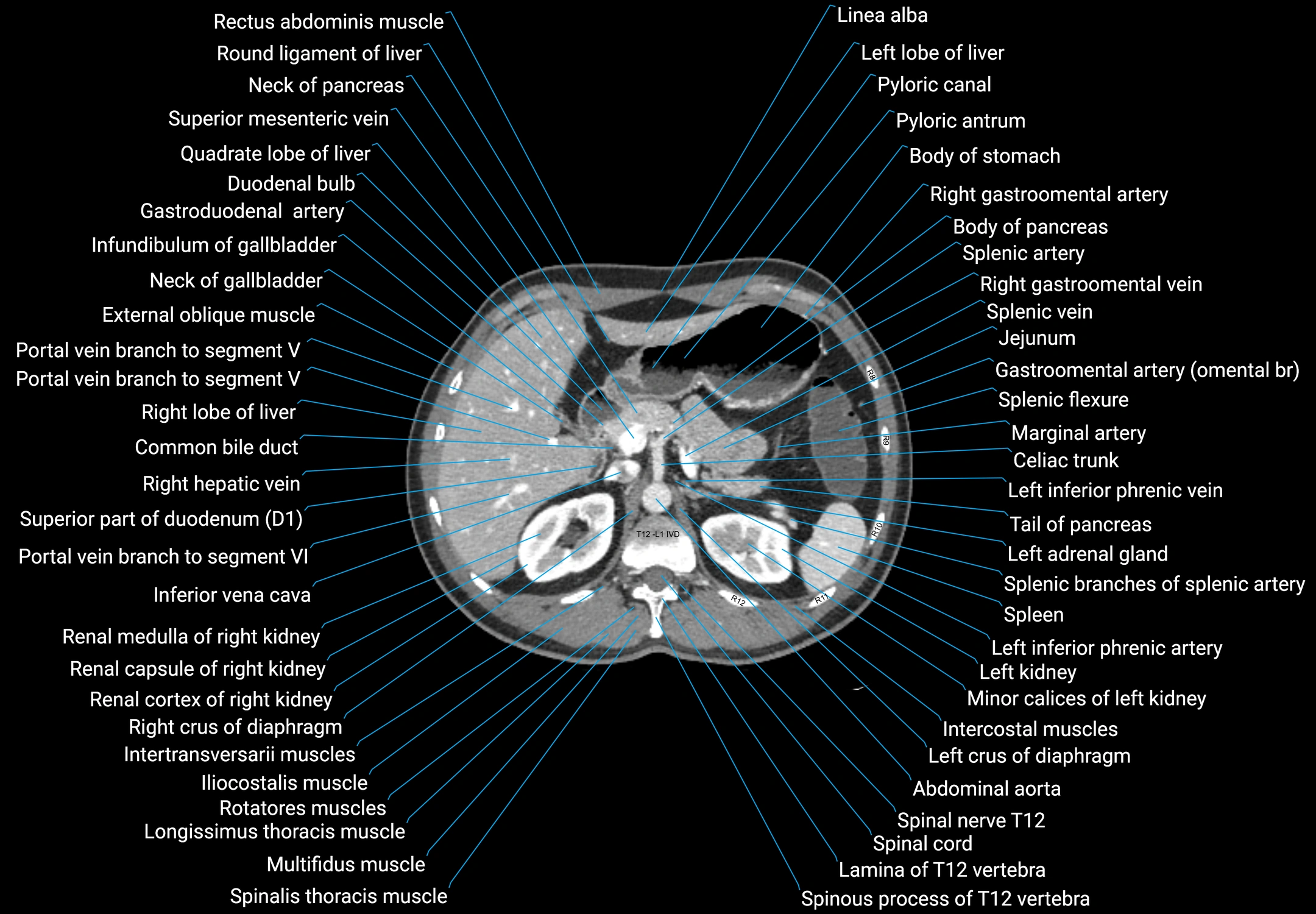 CT male pelvis axial cross sectional anatomy labelled radiology image -00048.webp